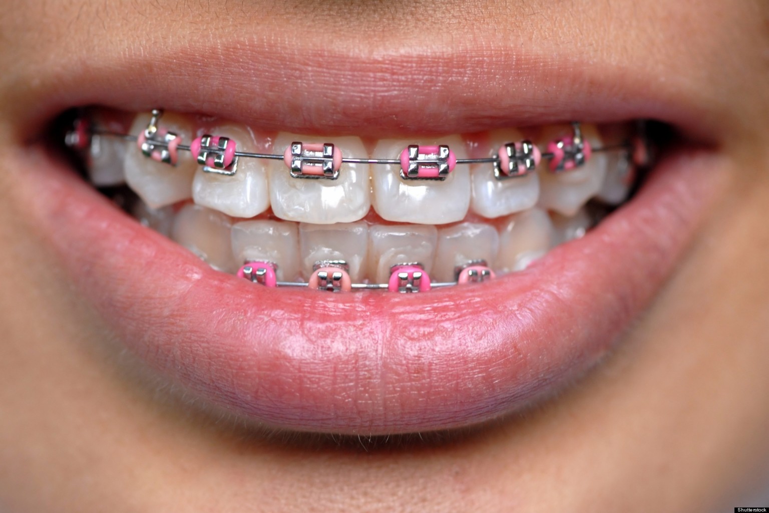o-FAKE-BRACES-facebook